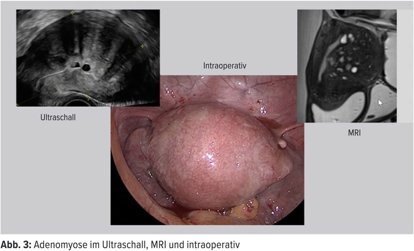 Endometriose Und Kinderwunsch Wie Kann Ich Meine Patientin Optimal